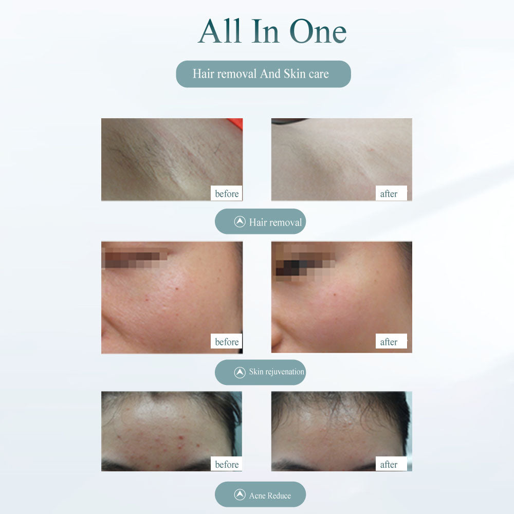 GlowPulse — IPL Hair Removal Device